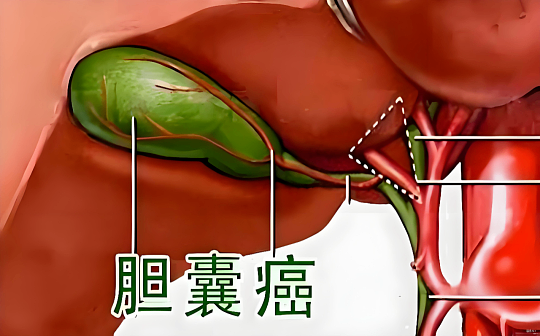 一颗小石头磨出的 “夺命癌”：别等胆囊喊疼才重视它