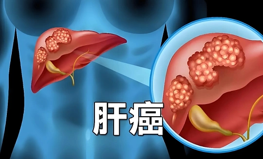 肝癌术后复发率竟高达70%？关于肝癌的这些“硬核”干货，不容错过！