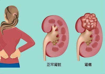 平时没疼没痒 一查竟是肾癌！这个 “沉默杀手” 专挑这些人下手