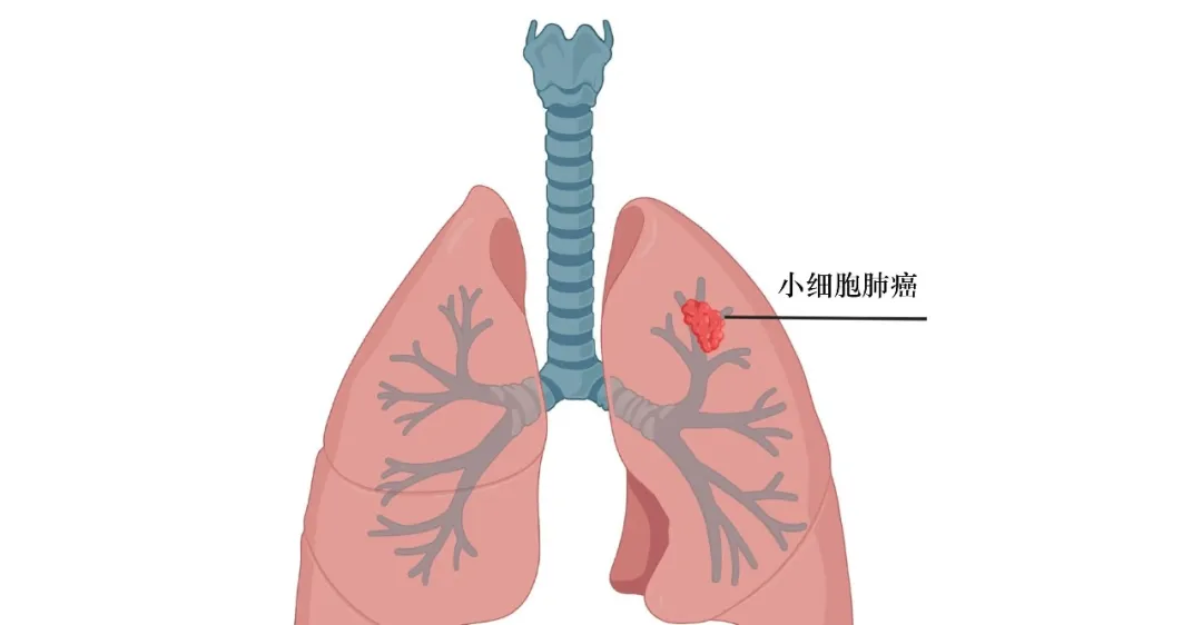 肺癌里的“鬼门关”——小细胞肺癌！