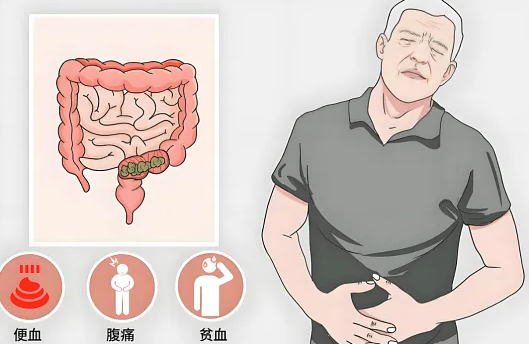 肿瘤不是 “快刀斩乱麻”：直肠癌治疗，有时 “慢一步” 效果更好