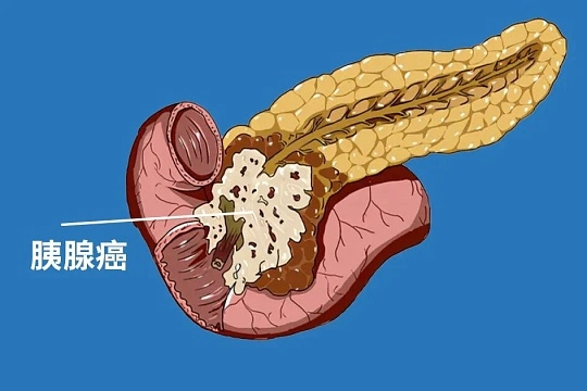 拉肚子别只当肠胃病！小心“癌王”胰腺癌，这些信号别错过